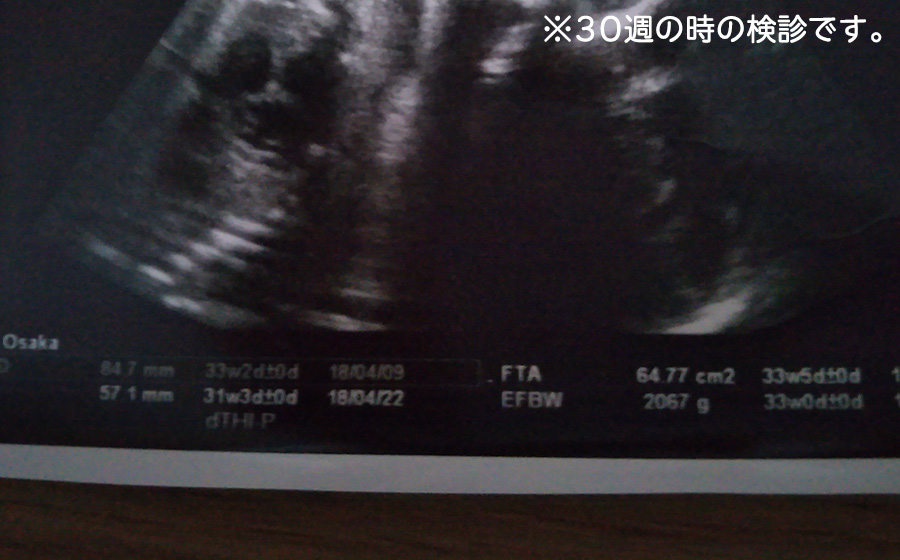 妊娠8 9ヶ月 赤ちゃんが大きい Hypの勝手に暮らそうか 妊娠8 9ヶ月 赤ちゃんが大きい Hypの勝手に暮らそうか